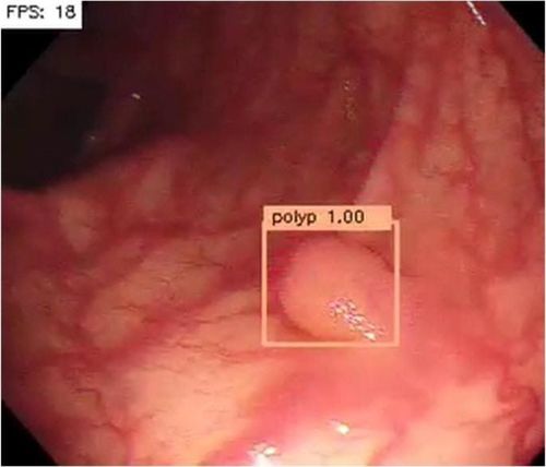 
Hình ảnh nội soi có sử dụng trí tuệ nhân tạo: máy tính tự động tìm và định vị polyp, đánh giáp polyp đó bao nhiêu phần trăm ung thư
