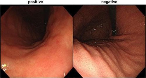 
Hình ảnh nội soi đại diện của Helicobacter pylori dương tính và dạ dày âm tính. Teo và đỏ lan tỏa được nhìn thấy khi có nhiễm H.pylori. Một sự sắp xếp đều đặn của các tiểu tĩnh mạch thu thập (RAC) được nhìn thấy trong dạ dày không bị nhiễm H.pylori
