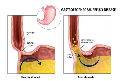 
Trào ngược dạ dày thực quản (GERD) là một bệnh lý về đường tiêu hóa (GI) phổ biến
