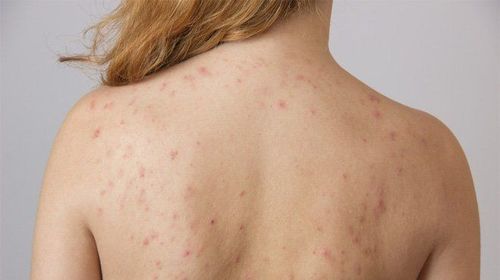 Nổi mụn đỏ ở lưng và phía trước ngực là dấu hiệu của bệnh gì?