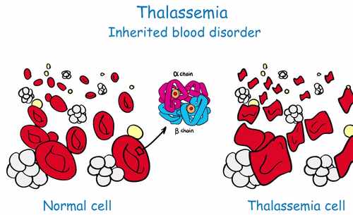 Trẻ xét nghiệm điện di huyết sắc tố có chỉ số Hb Bart’s chiếm 19% có nguy cơ mắc bệnh Thalassemia không?