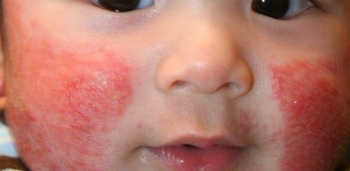 What happens to a child with eczema?