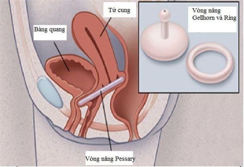 
Vòng nâng đặt trong âm đạo
