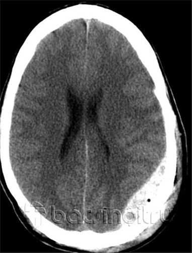 What is the role of MRI in the diagnosis of meningiomas?