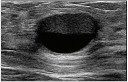 
Hình 3: Bệnh nhân nữ 29 tuổi, sau sinh 10 tháng, có khối ở vú phải. Hình ảnh siêu âm thấy khối dạng nang bờ rõ có mức mỡ - dịch, điển hình cho nang bọc sữa.
