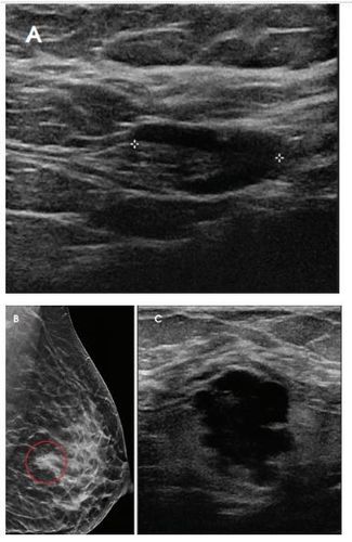 
Hình 1: Bệnh nhân nữ 34 tuổi đang cho con bú, (C ) siêu âm thấy khối hồi âm kém, bờ không đều, (B) nhũ ảnh thấy khối bờ không đều vùng trung tâm vú, (A) hạch nách vỏ dày. Sinh thiết có kết quả ung thư ống tuyến xâm lấn (IDC) với hạch nách di căn.
