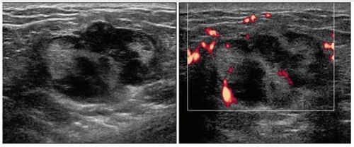 
Hình 2: Bệnh nhân nữ 33 tuổi đang cho con bú, hậu sản 1 tháng, có khối cứng vú phải. Siêu âm thấy khối hồi âm kém không đồng nhất, trục song song, tăng tưới máu trung tâm và ngoại vi. Sinh thiết cho thấy Lymphoma tế bào B lan tỏa.
