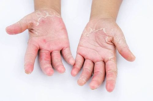 Cách điều trị dứt điểm nấm chàm trên ngón tay trẻ 5 tuổi?