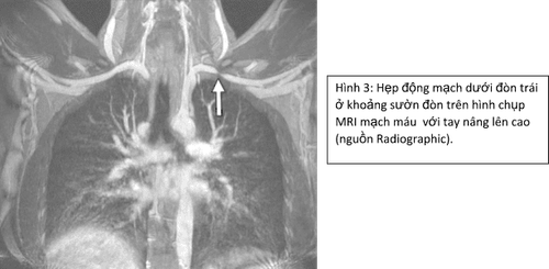 
Hình 3: Hẹp động mạch dưới đòn trái ở khoảng sườn đòn trên hình chụp MRI mạch máu với tay nâng lên cao (Nguồn: Radiographic)
