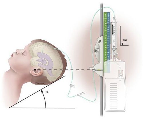 
Trên đây là các bước tiến hành phẫu thuật dẫn lưu não thất ổ bụng.
