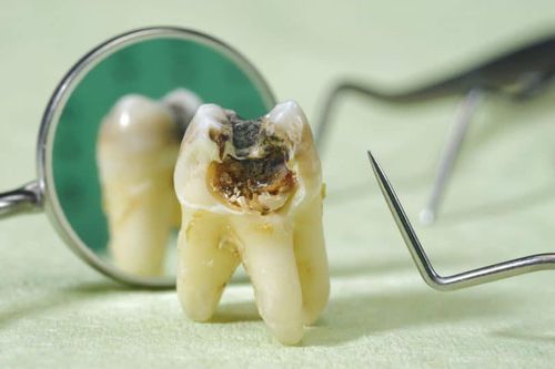 What is dentin caries? There is no cure?