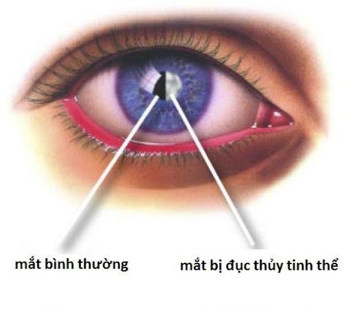 Mổ chữa đục thủy tinh thể có hiệu quả cao không?