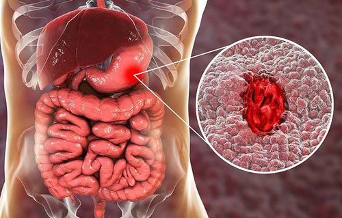 Bị xuất huyết dạ dày có được hoạt động mạnh không?