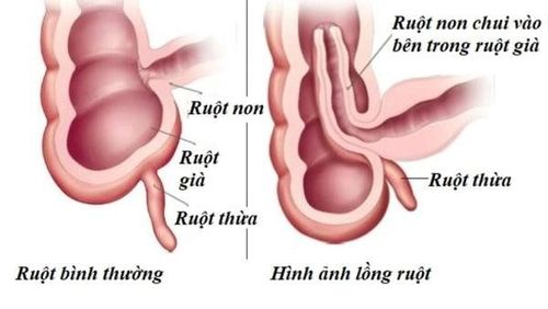 How to treat recurrent intussusception in adulthood?