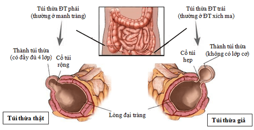 
Hình 1: Hình ảnh túi thừa đại tràng
