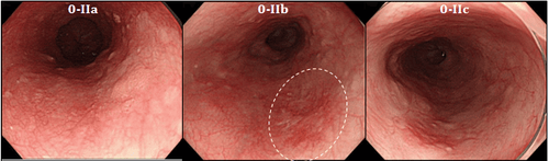 
Hình 2: Ung thư thực quản giai đoạn sớm được nhìn thấy qua nội soi
