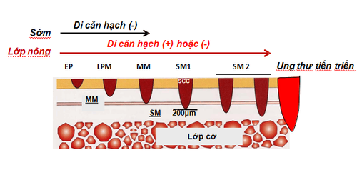 
Hình 3: Phân chia giai đoạn của ung thư sớm thực quản
