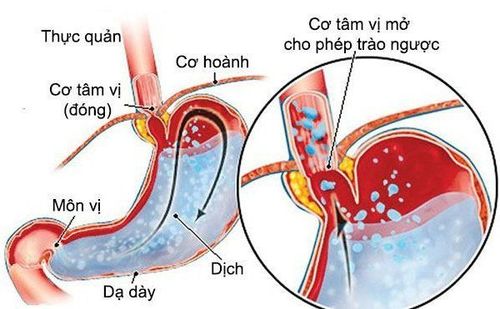 Liệt dây thanh quản trái gây trào ngược thức ăn sau khi ăn có cần điều trị ngay không?