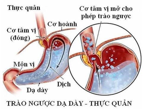 Siêu âm giúp đánh giá tình trạng trào ngược dạ dày thực quản