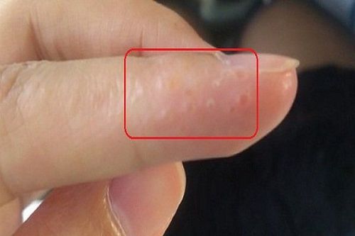 Nổi mẩn đỏ rát và ngứa rát các đầu ngón tay là dấu hiệu bệnh gì?