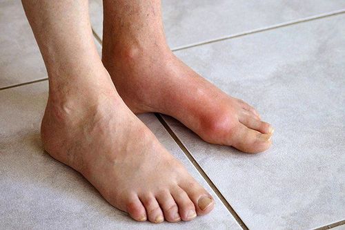 Có điều trị hết được gout mãn tính không?