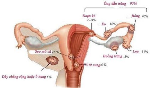 Vị trí mổ lấy thai ở ống tử cung có ổ tụ dịch kích thước 10x4,5mm khó thụ thai có đúng không?