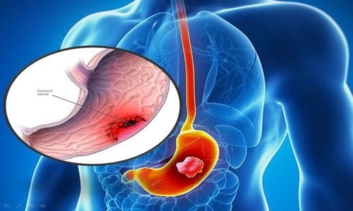 Test results: CA 72-4: 235; Cyfra: 3.3 is gastrointestinal and lung cancer?