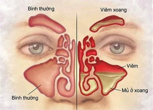 Hay ngạt mũi, dịch nhiều chảy xuống họng, ngứa và ù tai kèm đau nhức vai gáy có phải do viêm xoang gây ra không?