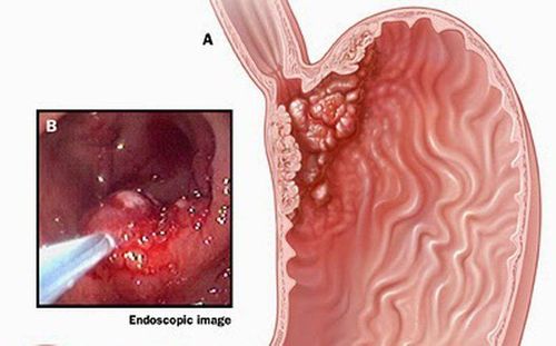 Gastroscopy results are TD K body, antrum is stomach cancer?