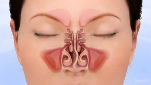 Vẹo vách ngăn mũi và có triệu chứng nghẹt thở, khó thở kèm viêm mũi phải làm thế nào?
