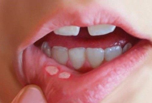 Bị nhiệt miệng tái phát nhiều lần phải làm sao trị khỏi?