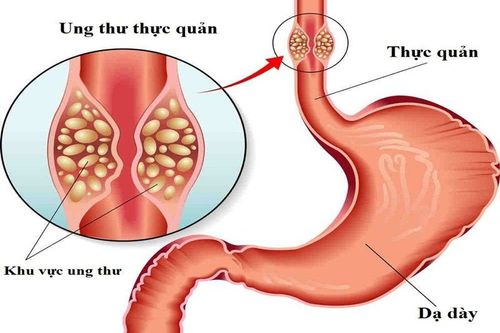 Ung thư thực quản giai đoạn 4 di căn gan có chữa được không và theo phương pháp nào?