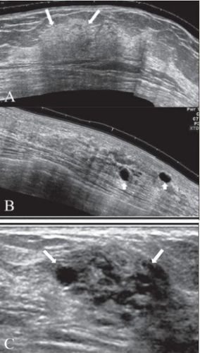 
(A-C) Thay đổi xơ nang (Thay đổi sợi bọc tuyến vú). Hình ảnh mở rộng (A,B) cho thấy một vùng dày lên khu trú của nhu mô tuyến vú (A) với tăng độ hồi âm khu trú (mũi tên) và các nang thành mỏng, đơn lẻ, rải rác (đầu mũi tên trong hình B). Khối u có thể biểu hiện phối hợp chùm nang nhỏ và nhu mô hồi âm dày (mũi tên trong hình C)
