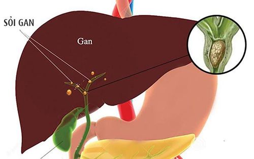 Is the cause of cirrhosis related to gallstones?