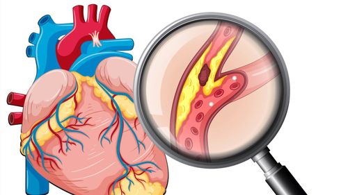 What is type D2 cardiovascular disease?