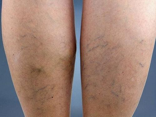 Having blue veins under the skin and numbness in the legs when standing for a long time is varicose veins?