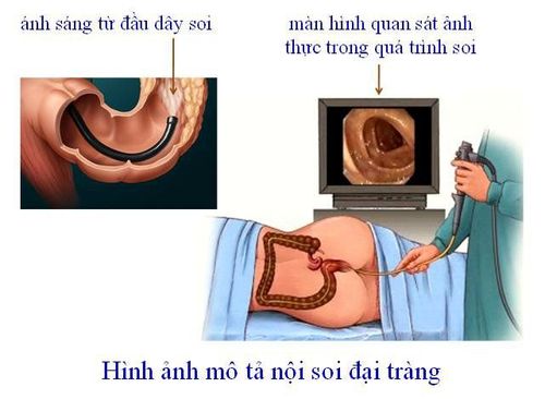 Can colonoscopy detect spasm of the colon?