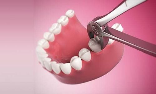 Mất răng hàm số 7 có ảnh hưởng như thế nào khi trồng răng Implant không?