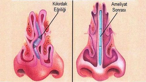 Đã phẫu thuật vẹo vách ngăn nhưng thường xuyên nghẹt một bên mũi có phẫu thuật lại được không?