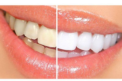 Causes of discolored teeth