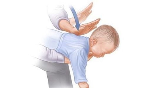 
Thủ thuật Heimlich có tác dụng đẩy theo dị vật ra ngoài thanh môn
