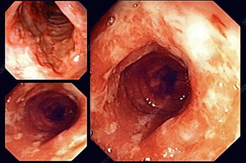 Role of small bowel endoscopy in the diagnosis of inflammatory bowel disease in children and adults