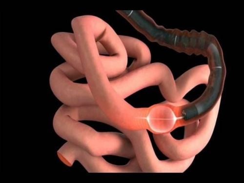 Role of small bowel endoscopy in the treatment of small bowel strictures due to inflammatory bowel disease