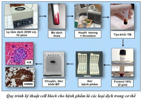 
Phương pháp khối tế bào dịch màng phổi
