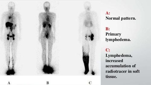 Imaging features of lymphedema