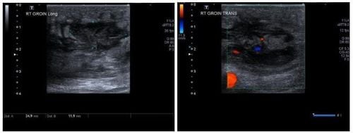 Imaging features of subcutaneous abscesses