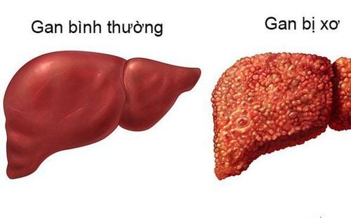 Cirrhosis 11.7kpa (f3-f4) people who are tired, eat or full, is cirrhosis decompensated or compensated?