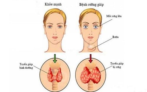 Đang uống thuốc điều trị cường giáp sử dụng thuốc tránh thai hàng ngày Rigevidon thì có ảnh hưởng gì không?