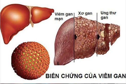 How is cirrhosis of the liver in people with chronic hepatitis B treated?