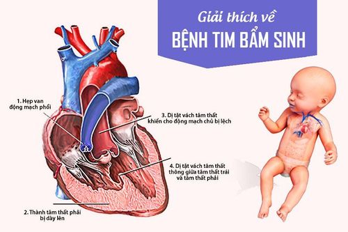 Bé 2 tháng tuổi bị bệnh tim bẩm sinh có cần can thiệp không?